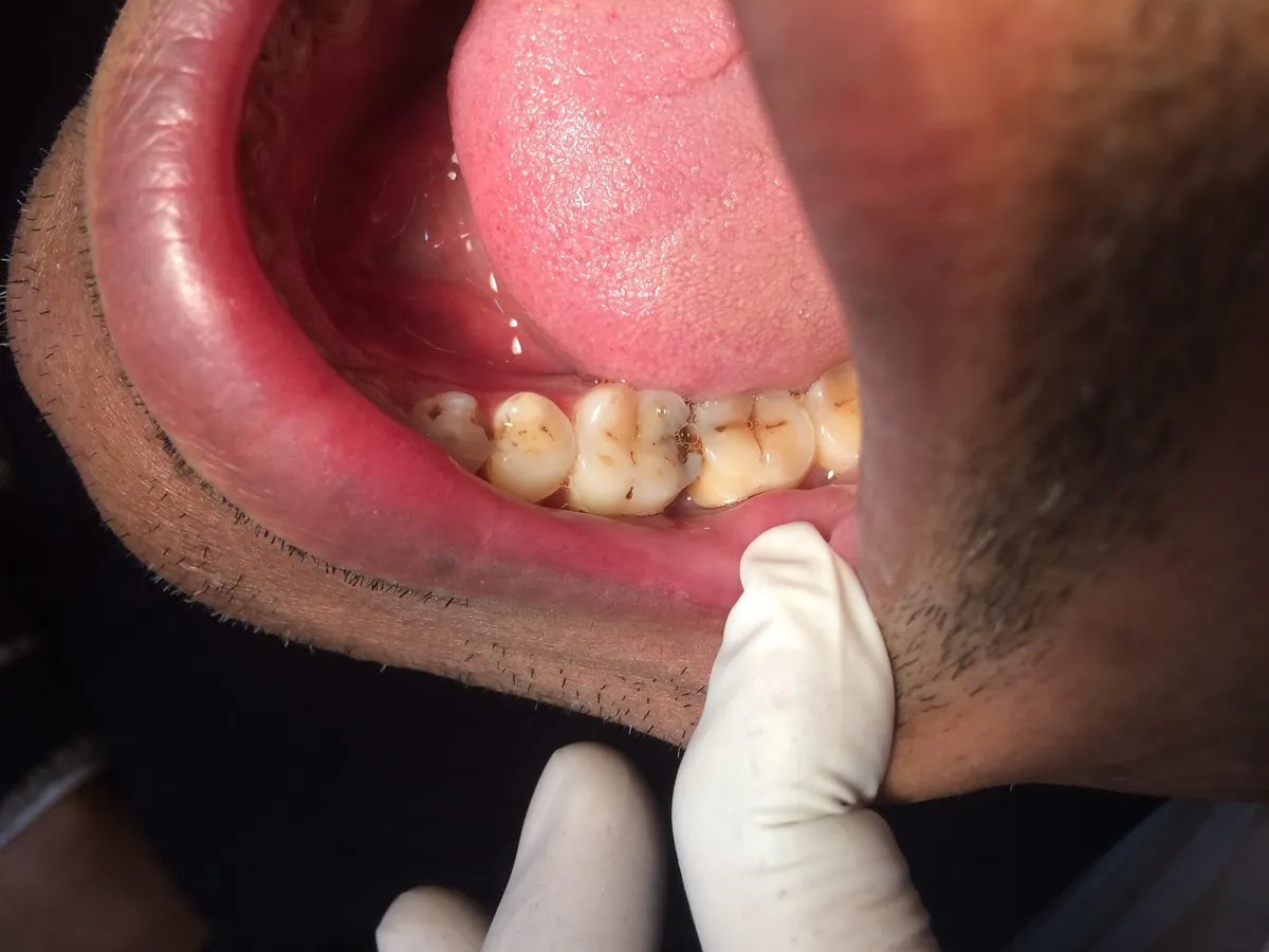 صورة توضيحية لخدمة علاج التسوس والعناية بالأسنان